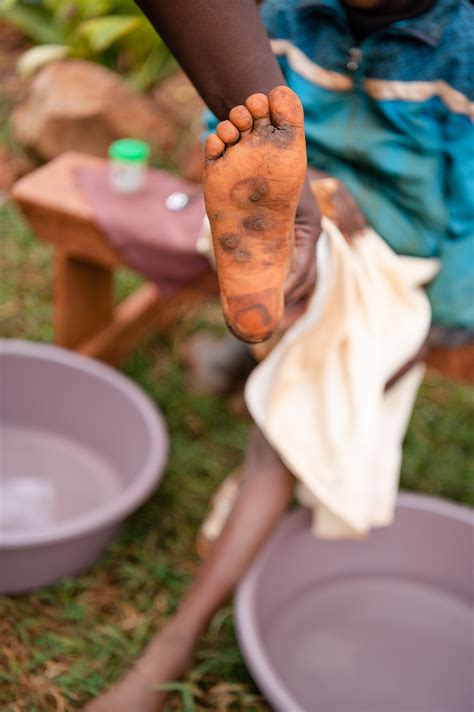 To soothe itchy feet, it is recommended to take a shower with hot water and rub the area where the hives are visible with soap and water. . Jiggers foot
